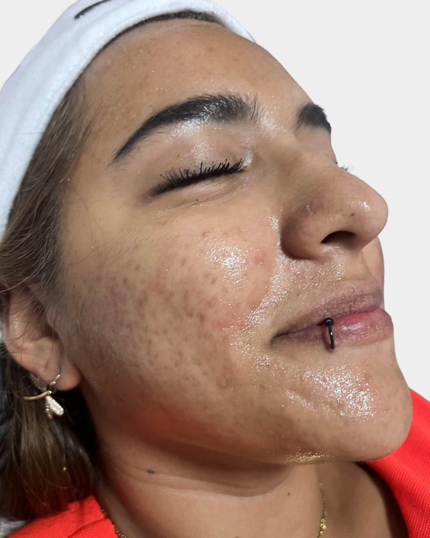 Antes de Tratamiento Acné